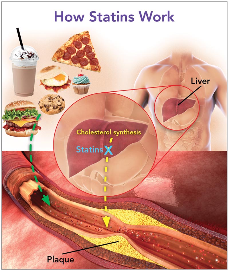 Saturated fat raises LDL (“bad”) cholesterol, which ends up as plaque in arteries. Statins make the liver produce less cholesterol and remove more LDL from the blood.