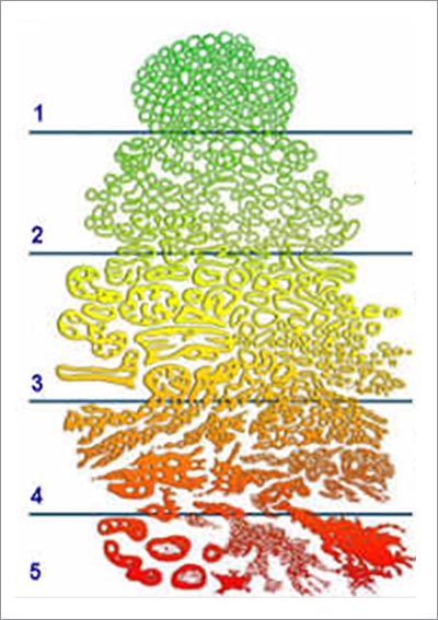If doctors are sure that your prostate harbors no cells with Gleason grade 4 or 5, your cancer is unlikely to cause harm.