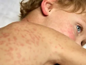 child sick with rubella lies covered with spots on a hospital bed