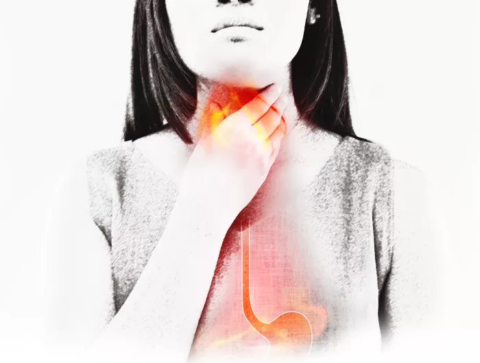 illustration of GERD