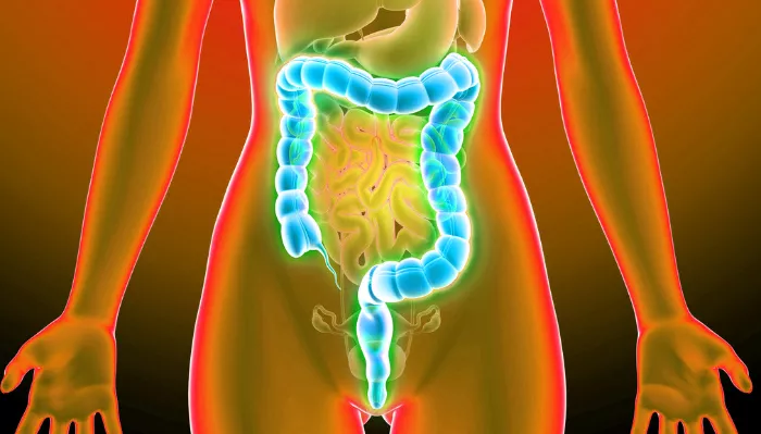 colon cancer