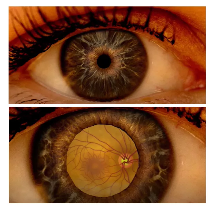 a dilated and undilated eye