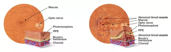 macular degeneration