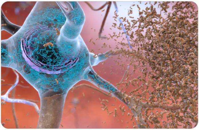 illustration of amyloid plaque around a tau tangle