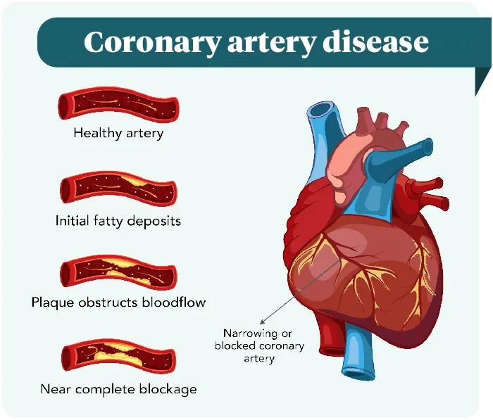 diagram of coronary artery build up
