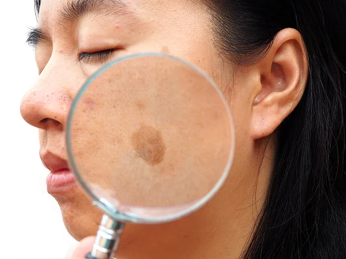 magnifying glass held up to dark melasma spot on woman's cheek
