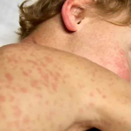 child sick with rubella lies covered with spots on a hospital bed